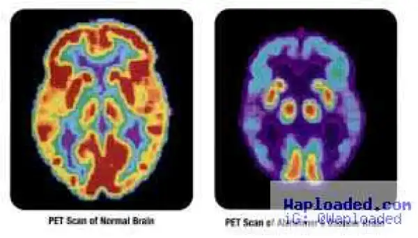 Scientists hopeful of new treatment for Alzheimer